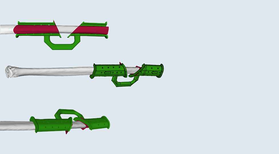 3D printing customized medical devices